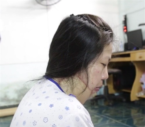 sau bao dau don kinh hoang, nguòi phụ nũ bị tạt axit mong chò ngay ke ac den toi - 2