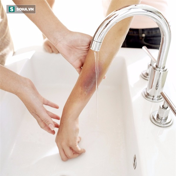 Trẻ bị bỏng cực nguy hiểm: BS mách cách sơ cứu bỏng chuẩn, làm cha mẹ nhất định phải biết - Ảnh 1.