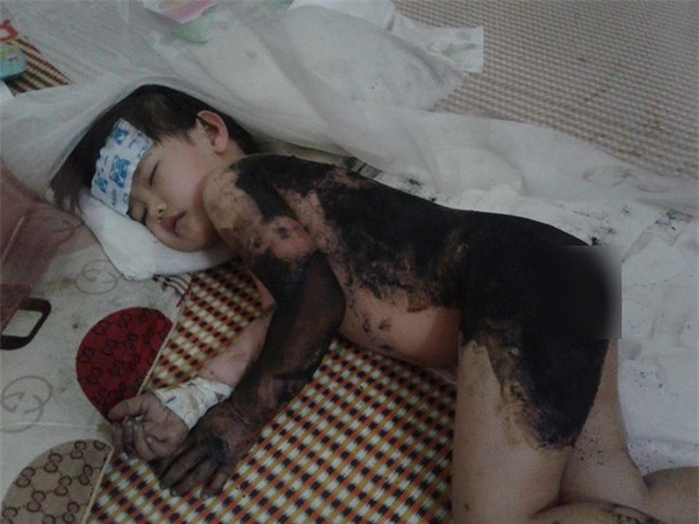 Hiện, Trang phải đắp thuốc toàn bộ phần bỏng. Để chữa trị dứt điểm thì phải mất ít nhất 1 tháng. Ảnh: Nông Thuyết