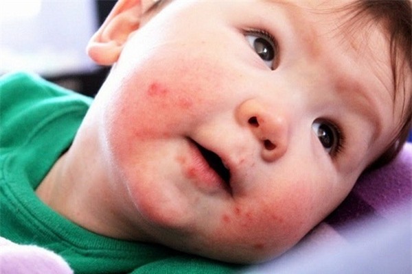 bệnh tay chân miệng