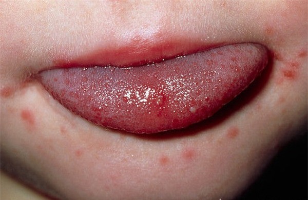 bệnh tay chân miệng