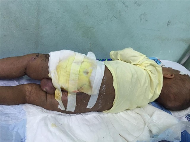 Chỉ vì chích nhọt, đắp lá mà bé trai bị nhiễm trùng máu, hoại tử da nguy kịch. Ảnh: L.M