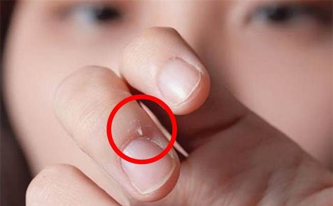 Bé 7 tuổi suýt bị cắt bỏ ngón tay vì thói quen "cắn": Bố mẹ nên "cai nghiện" cho con