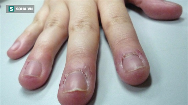 Bé 7 tuổi suýt bị cắt bỏ ngón tay vì thói quen cắn: Bố mẹ nên cai nghiện cho con  - Ảnh 3.