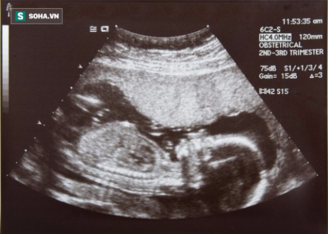 Siêu âm 6 lần trong suốt thai kỳ, mẹ chết ngất trước sự thật đau lòng khi con vừa chào đời - Ảnh 1.