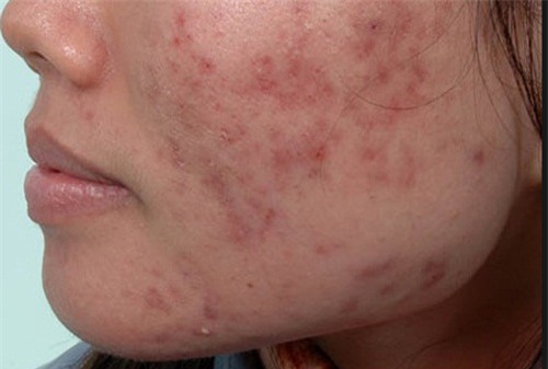 tron nuoc dua va mat ong roi thoa len mat, seo va vet tham se dan dan mat het - 1