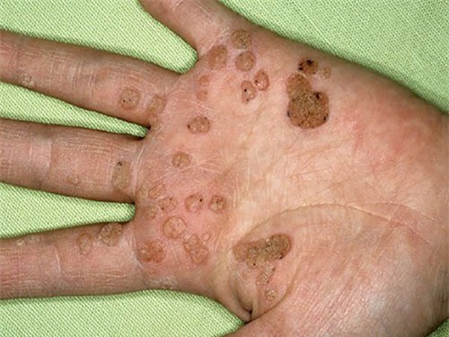 lam sao de mun coc sinh duc khong bien chung thanh ung thu? - 1