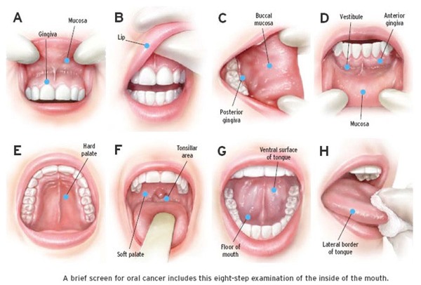 Ngày càng nhiều người bị bệnh ung thư miệng chỉ vì giữ những thói quen này hàng ngày - Ảnh 3.
