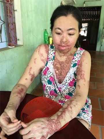 Uẩn ức người đàn bà bị tạt axít giữa Sài Gòn