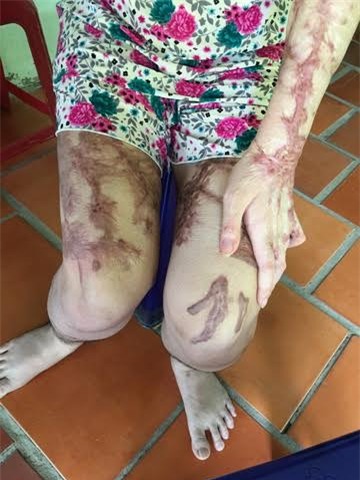 Uẩn ức người đàn bà bị tạt axít giữa Sài Gòn