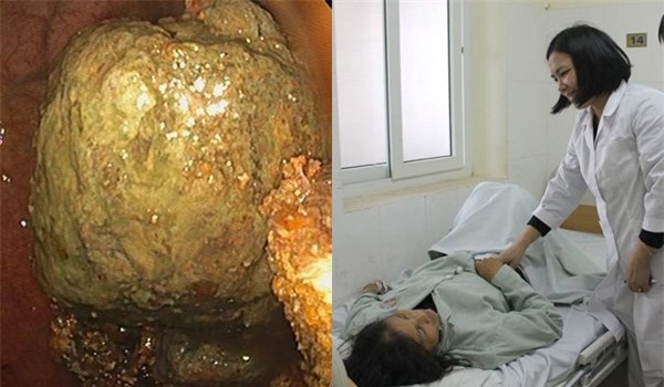 Suýt thủng ruột vì ăn hồng giòn