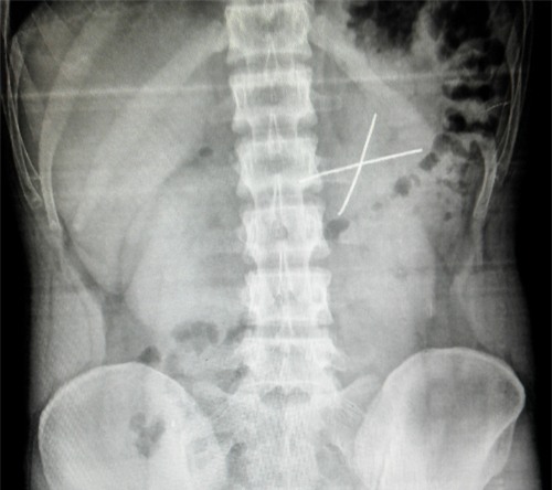 kết quả chụp X quang bụng cho thấy dị vật có dạng chữ X.