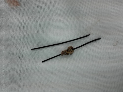 Hai đoạn dây kẽm dài 8cm được lấy ra ngoài. Ảnh: T.P