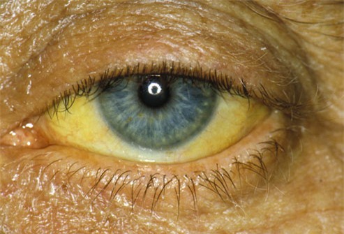 Rất ít người mắc căn bệnh này sống thêm được 5 năm: Đây chính là dấu hiệu cảnh báo sớm! - Ảnh 2.