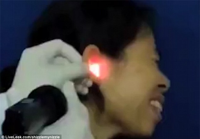 Rùng mình cảnh con gián bị gắp ra khỏi lỗ tai nhưng vẫn cựa quậy - Ảnh 2.