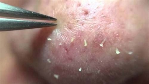 liet, mu… va nhieu hau qua kinh khung khac neu ban nan mun “vo to chuc” - 4