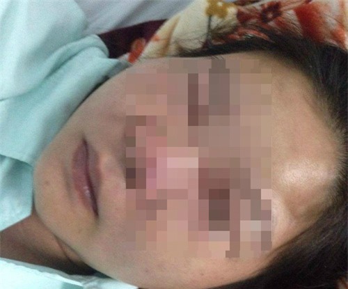nguòi phụ nũ suýt chét vì nạn mụn ỏ vùng mũi - 1