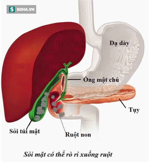 Hậu quả không ngờ của việc nhịn ăn sáng: Tiếp tay cho khối u tiền ung thư - Ảnh 2.