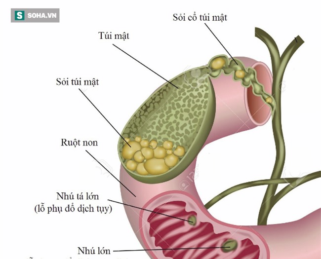 Hậu quả không ngờ của việc nhịn ăn sáng: Tiếp tay cho khối u tiền ung thư - Ảnh 3.