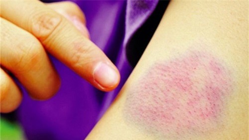 chu quan voi vet bam tim tren da, nam benh nhan tu vong vi xuat huyet nao - 2