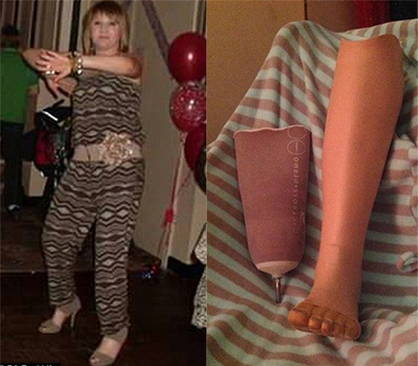 Làm điều này khi đi giày cao gót, người phụ nữ đã phải cắt cụt một chân - Ảnh 2.