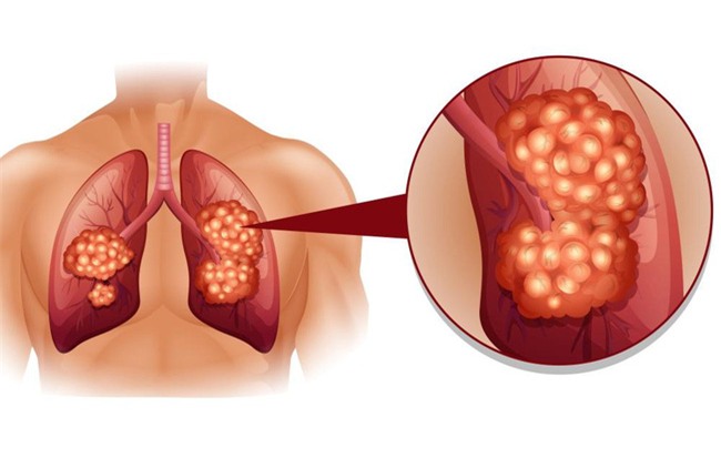 Nhiều người đã từng gặp 8 dấu hiệu này mà không biết đó là cảnh báo của bệnh ung thư phổi - Ảnh 1.