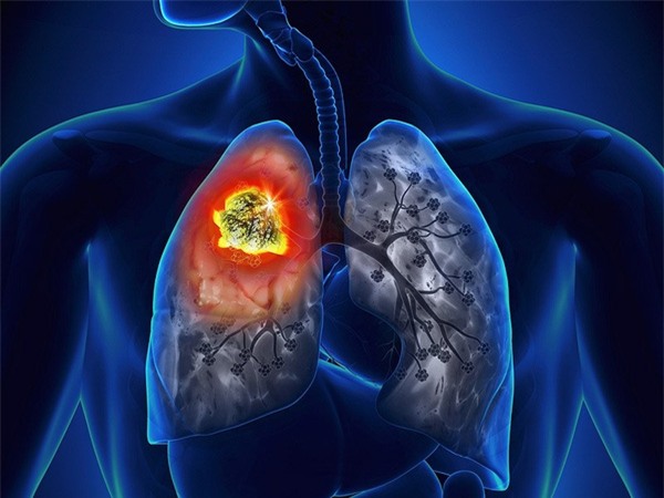 Nhiều người đã từng gặp 8 dấu hiệu này mà không biết đó là cảnh báo của bệnh ung thư phổi - Ảnh 2.