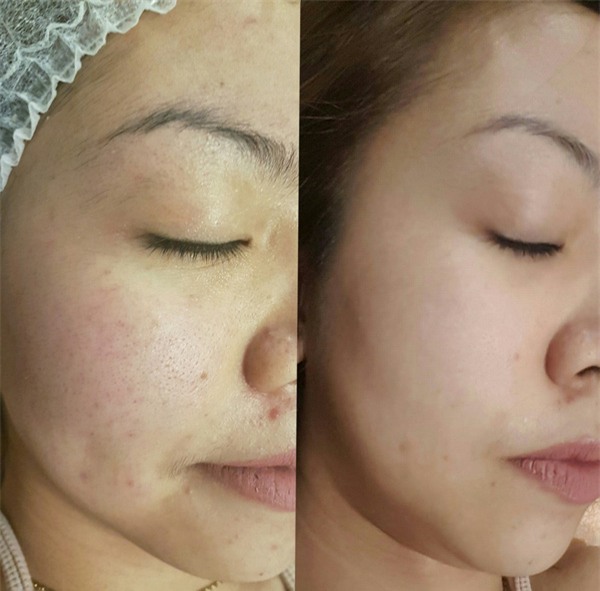 3 phương pháp thẩm mỹ da được dự đoán là sẽ rất đắt hàng dịp cuối năm - Ảnh 8.