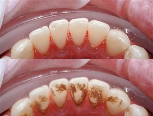 Cứ ngậm súc thứ nước thần này đi rồi cao răng bật ra từng mảng, hôi miệng cũng không còn - Ảnh 2.