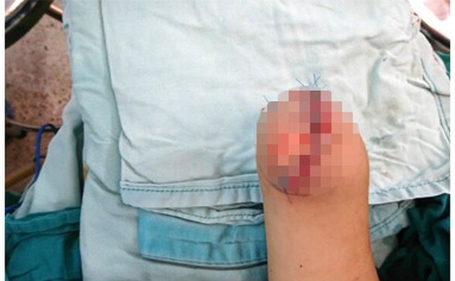 Bé trai 3 tuổi mất một mắt và một bàn tay vì cục sạc gắn thêm cho xe máy