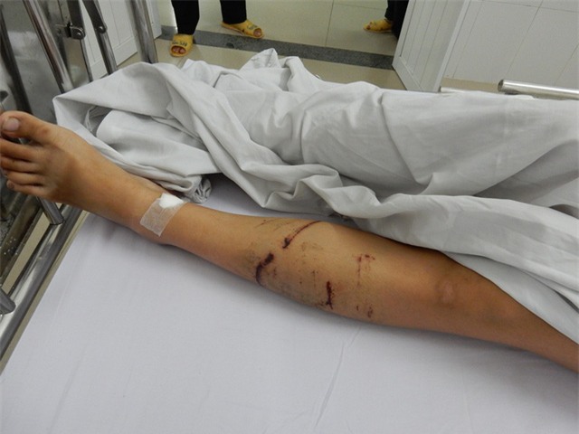 Dưới chân cũng bị trầy xước
