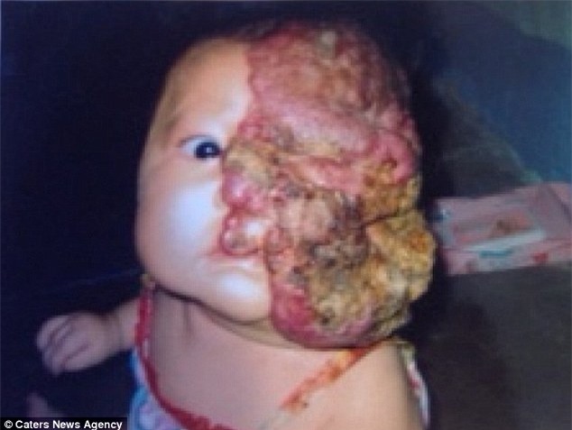 Bé gái 5 tuổi mang khối u che hết nửa gương mặt bất ngờ được một người xa lạ cứu sống - Ảnh 1.