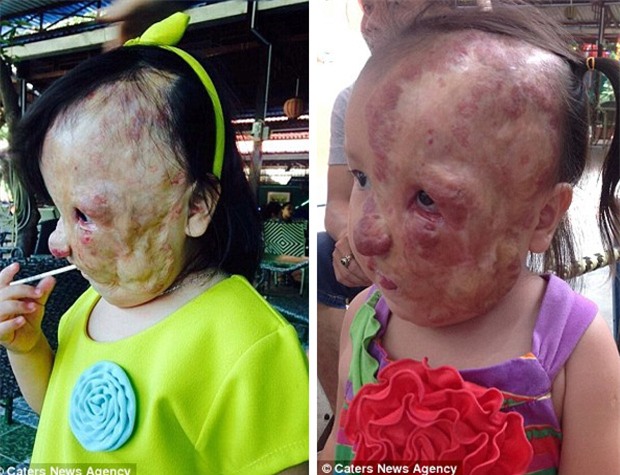 Bé gái 5 tuổi mang khối u che hết nửa gương mặt bất ngờ được một người xa lạ cứu sống - Ảnh 3.
