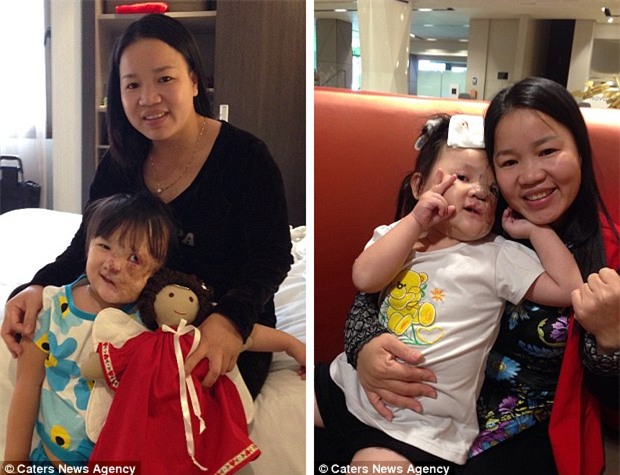 Bé gái 5 tuổi mang khối u che hết nửa gương mặt bất ngờ được một người xa lạ cứu sống - Ảnh 4.