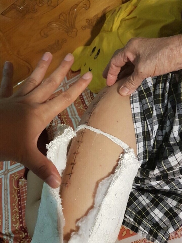 Vết thương dài sau khi mổ chân của học sinh Kiên. Ảnh GĐCC