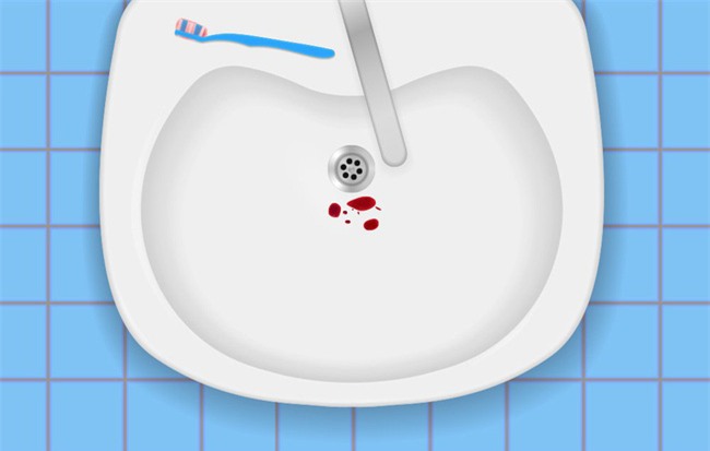 Những nguyên nhân gây chảy máu răng bạn nhất định không được chủ quan - Ảnh 1.