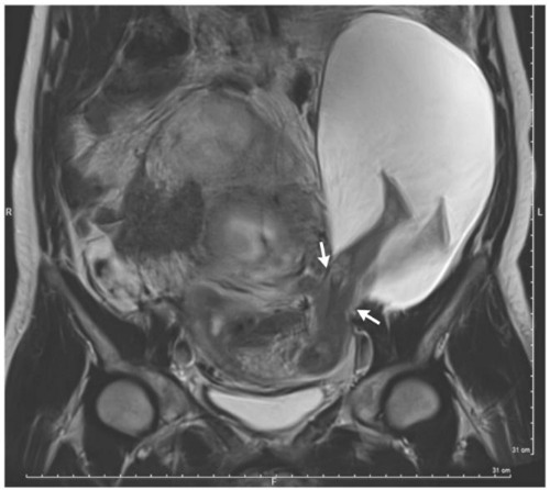 thai-nhi-dap-chan-rach-tu-cung-me