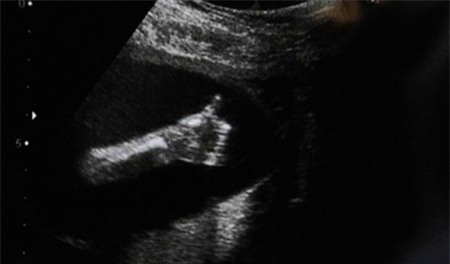 Hình ảnh Những biểu hiện chết cười của thai nhi trong bụng mẹ số 3