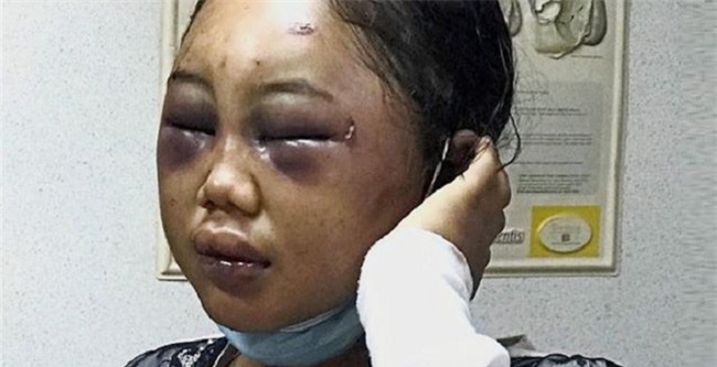 Nữ giúp việc 19 tuổi người Indonesia bị bà chủ Malaysia bạo hành dã man - Ảnh 1.