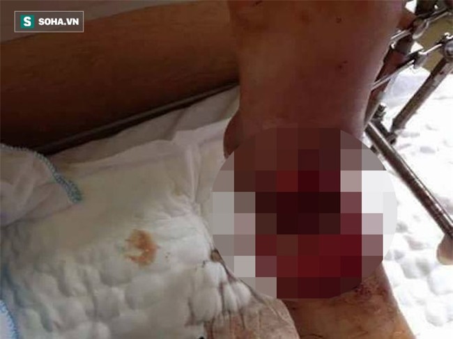 Con gái bị tai nạn có nguy cơ phải cắt cụt chân, cha nghèo cắm sổ đỏ vay tiền chữa trị - Ảnh 3.