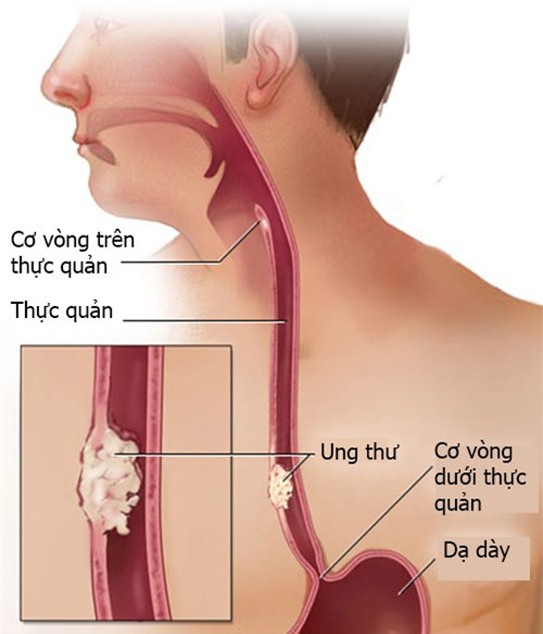 Bệnh ung thư thực quản đang gia tăng vì 3 cách chế biến thức ăn sai lầm này - Ảnh 2.