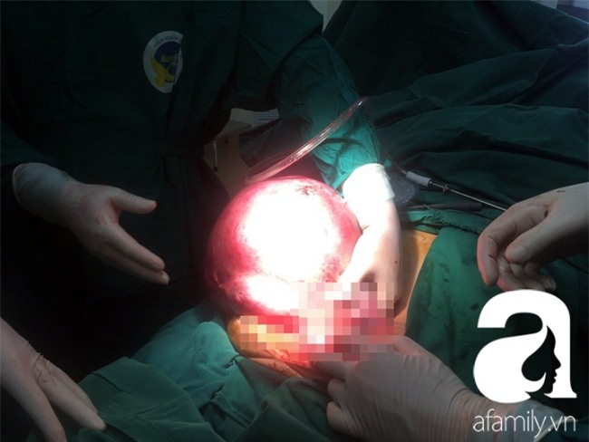 Cứu sống một phụ nữ mang khối u trong tử cung nặng đến…12kg - Ảnh 2.