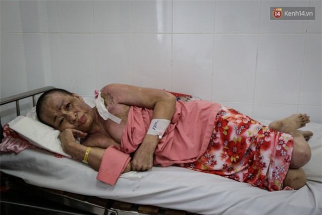 Không móc cống nghẹt, người phụ nữ ở Sài Gòn bị tạt nồi thịt sôi vào người gây bỏng nặng - Ảnh 1.