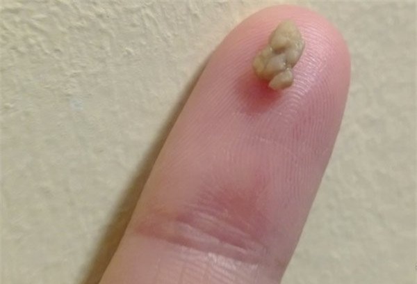 Miệng bốc mùi là do căn bệnh nguy hiểm này - Ảnh 4.