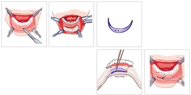 Cô nàng nghiện phẫu thuật thẩm mỹ tá hỏa vì 2 chiếc ốc vít nằm trong cằm độn - Ảnh 7.