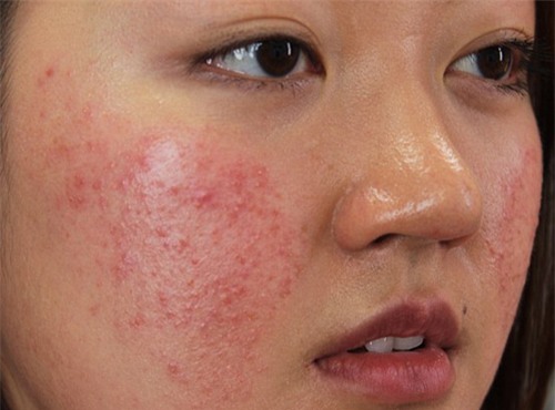 mun va vet tham se bien mat khong dau vet nho 1 phut thoa mat na moi ngay - 1