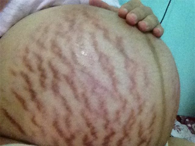 Mẹ bầu 9X dũng cảm khoe ảnh bụng rạn như ruộng hạn nhìn đến xót xa - Ảnh 1.