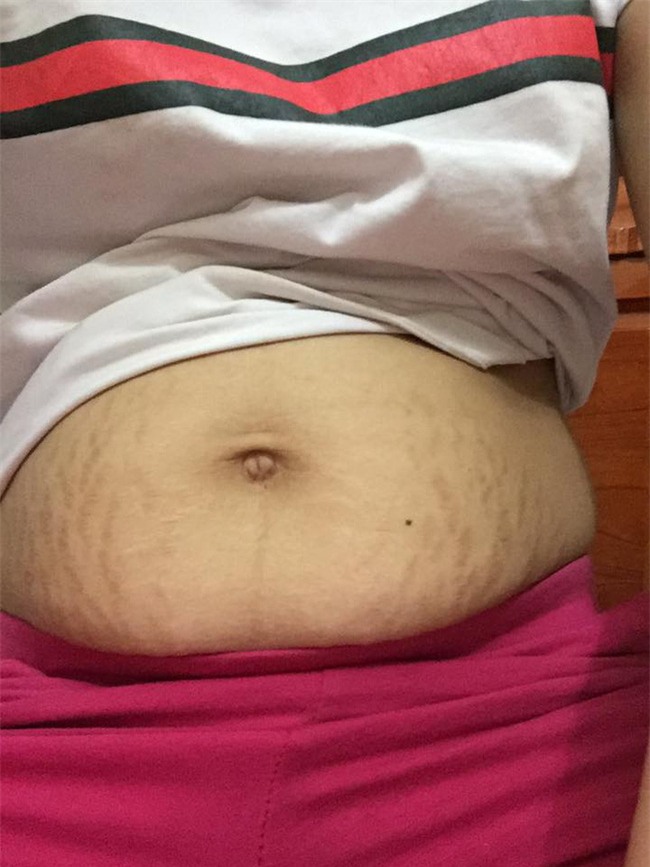 Mẹ bầu 9X dũng cảm khoe ảnh bụng rạn như ruộng hạn nhìn đến xót xa - Ảnh 3.