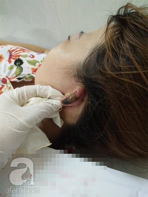 Chị em đi làm tóc cuối năm hãy cẩn thận: đã có người bị lột da đầu, người suýt mất tai - Ảnh 1.