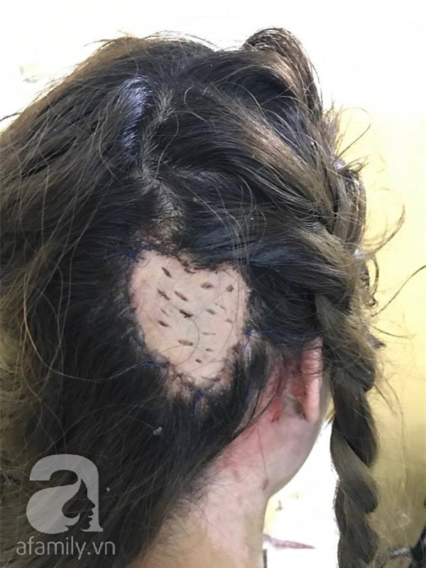 Chị em đi làm tóc cuối năm hãy cẩn thận: đã có người bị lột da đầu, người suýt mất tai - Ảnh 4.
